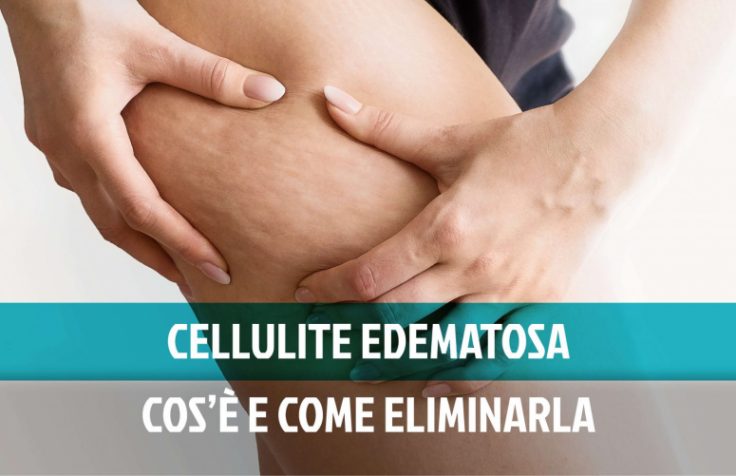 Cellulite edematosa: significato e come eliminarla