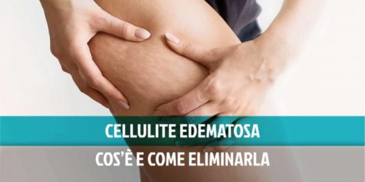 Cellulite edematosa: significato e come eliminarla